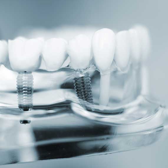 Implantologie (implant dentar)